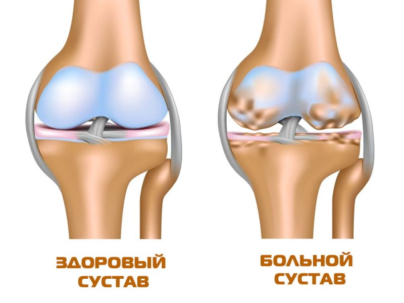 Лечение суставов колен